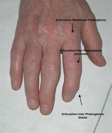 Arthrose Des Doigts Diagnostic Et Traitements Dr Roure