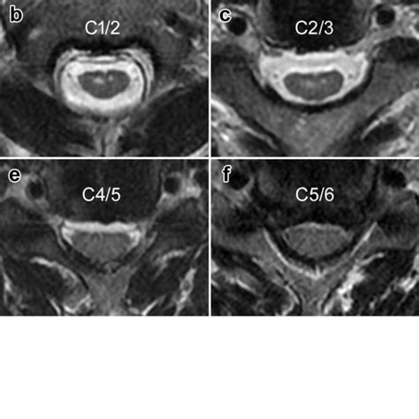 Case Sagittal A And Axial B C T Weighted MRI Of The Cervical Download Scientific