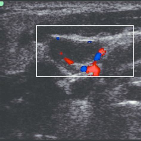 Gray Scale Color Doppler Ultrasound Image Of Round‑shaped Mitotic