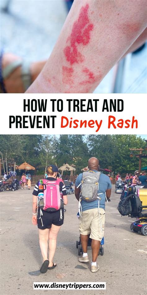 How To Treat And Prevent Disney Rash Pictures Tips And More Artofit