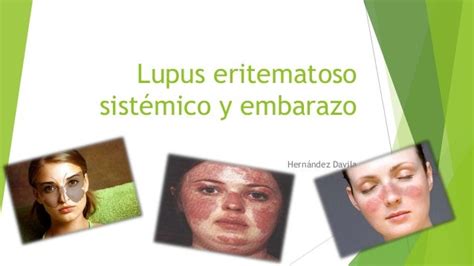 Lupus Eritematoso Sistémico Grafico Vectorial Lupus Eritematoso