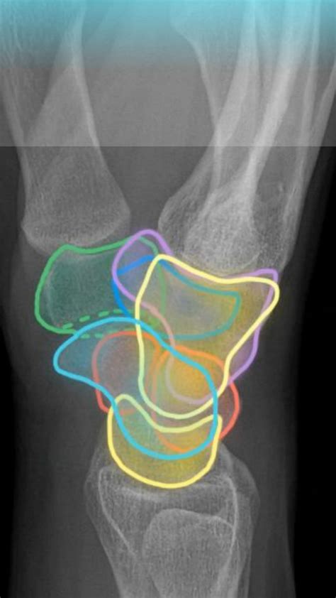 Wrist Anatomy Radiology