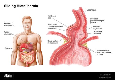 Medical Ilustration Of A Hiatal Hernia In The Upper Part Of The Stomach