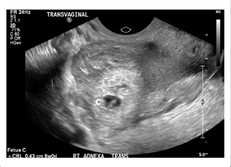 Transvag Ultrasound During Pregnancy Transvaginal Ultrasonography And