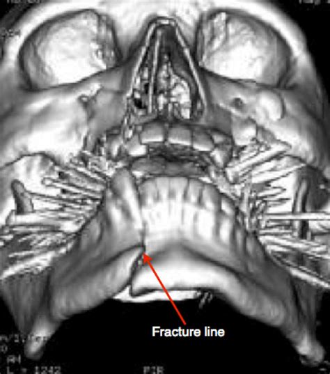 Jaw Fracture Facial Trauma