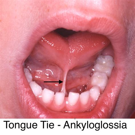 Tongue Tie And Lip Tie Frenectomy Lonestar Kids Dentistry