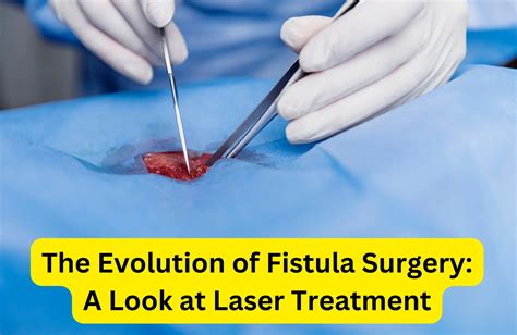 The Evolution Of Fistula Surgery A Look At Laser Treatment