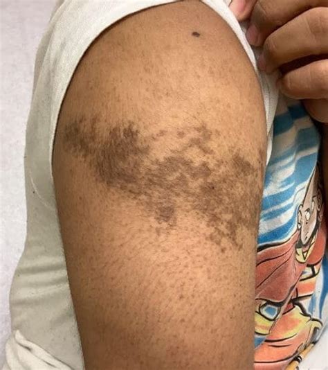 Dermdx Deeply Pigmented Lesion On Upper Arm Clinical Advisor