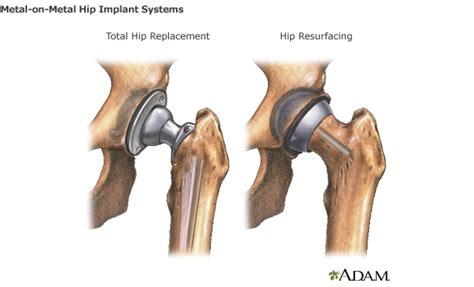 Metal On Metal Hip Implants Fda