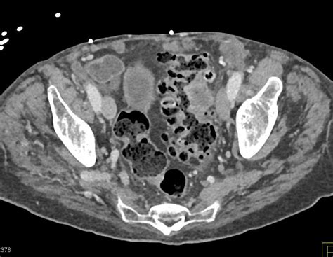 Perforated Stomach With Abscess Stomach Case Studies Ctisus Ct Scanning