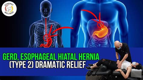 Gerd Esophageal Hiatal Hernia Type 2 Dramatic Relief Youtube