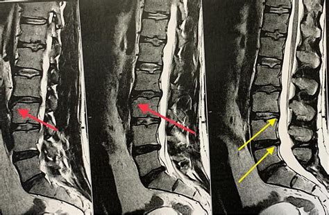Cureus Limbus Vertebrae As Incidental Finding In A Patient With Acute