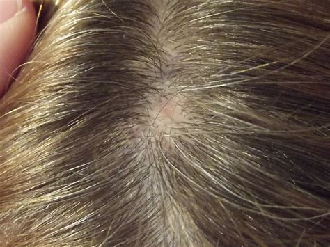 Painless Lump On Scalp Ive Had This Lump On My Head For A Few Years