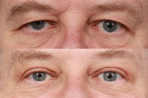 Upper Eyelid Lift And Brow Lift 3 Months Post Op Before And After Gallery