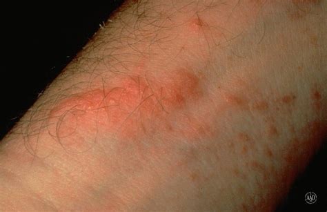 Treating Poison Ivy Ease The Itch With Tips From Dermatologists
