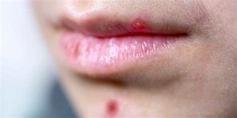 Top 9 White Head Pimple On Lip 2022