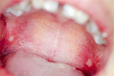 Causes For Bumps On The Roof Of Your Mouth Part 1