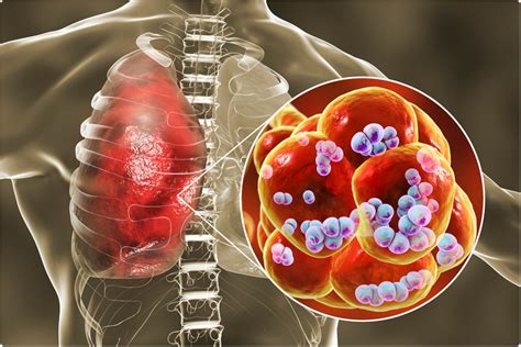 Streptococcus Pneumoniae Modulates Host Immunity To Sars Cov 2 News