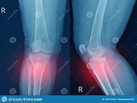 X Ray Knee Fracture Proximal Metaphysis Of Tibiadepressed Fracture Of