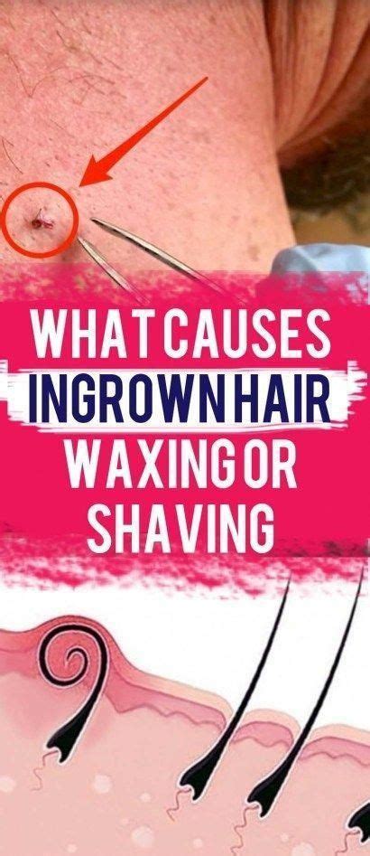 What Causes Ingrown Hair Waxing Or Shaving All About Woman Life Style