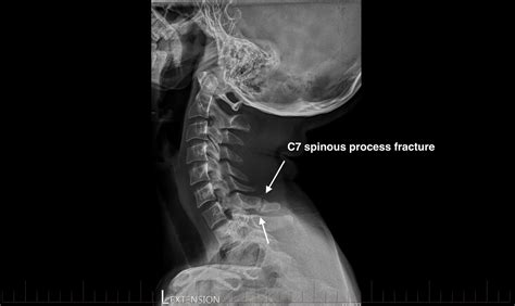 Radiology Review C7 Spinous Process Fracture Axis Sports Med