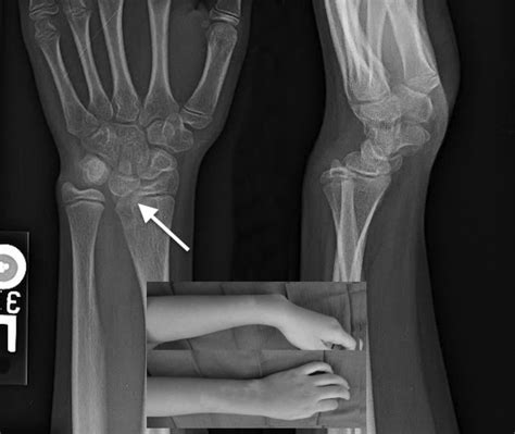 Madelungs Deformity Hand Surgery Source
