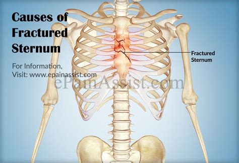 Is it common for chest contusion pain to go away after 3 months, then come back after a couple of weeks of no pain? answered by dr. Fractured Sternum|Causes|Symptoms|Treatment|Exercise ...