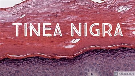 Tinea Nigra Black Mold Skin Infection Dematiaceous Pigmented Fungus