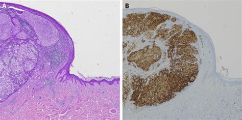 A Dermal Proliferation Of Atypical Achromic Melanocytes With Nodular