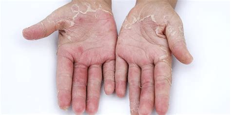 Peeling Skin On Hands Causes Symptoms For No Reason