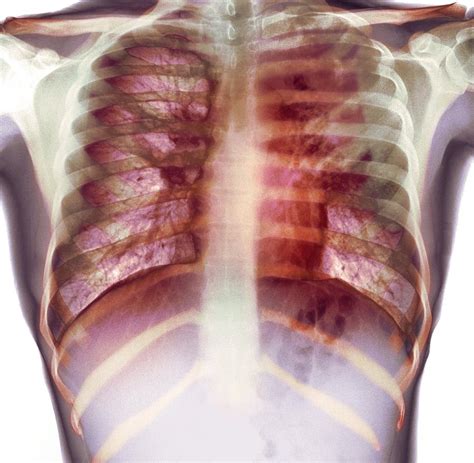 Tuberculosis X Ray Photograph By Du Cane Medical Imaging Ltd Fine