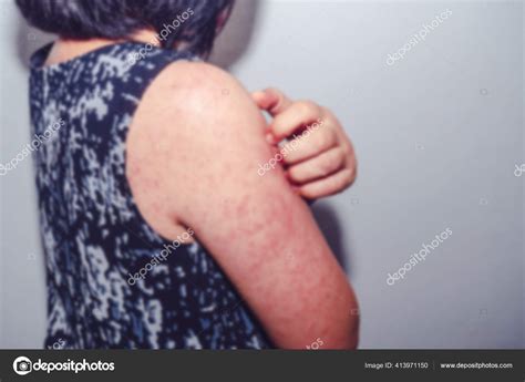 Blurred Images Dermatitis Measles Virus Woman Dermatitis Her Itchy
