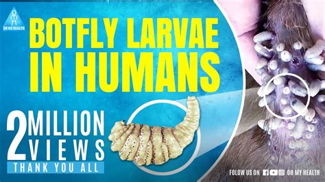 Botfly Larvae In Humans Youtube