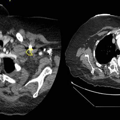 Axial Ct Thorax Showing Left Supraclavicular And Axillary Adenopathy