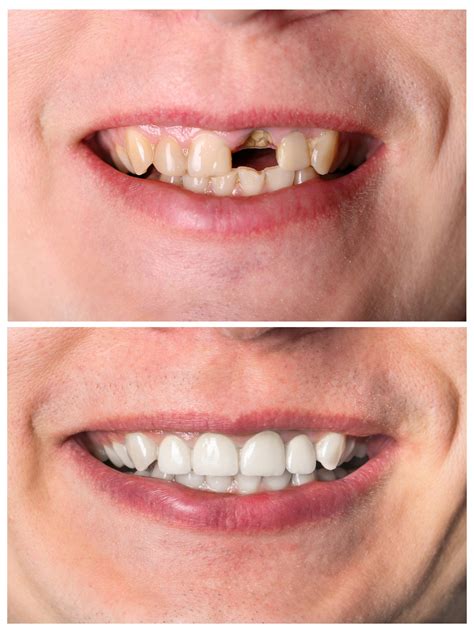 Tooth Restoration And Restorative Dentistry In Murfreesboro Tn