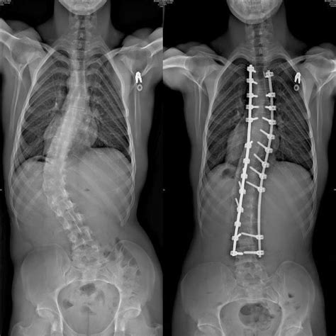 Pin By Tahri On My Job Scoliosis Spinal Fusion Scoliosis Surgery