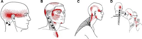 Tension Type Headache Treated By Positional Release Therapy A Case