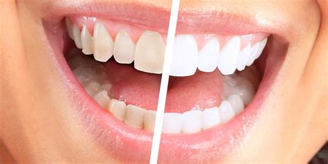 Professional Teeth Whitening In Alexandria King Centre Dental
