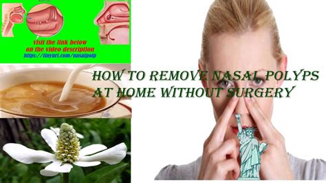 Nasal Polyps Treatment Top 12 Natural Remedies For Nasal Polyps Nasal Polyps