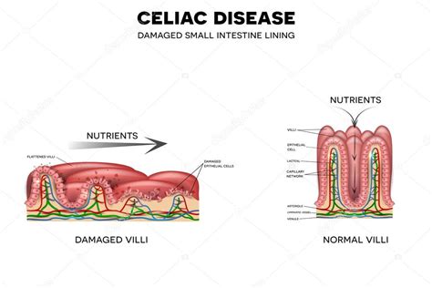 Celiac Disease Affected Intestinal Villi — Stock Vector © Megija 109991868