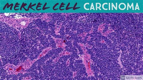 Merkel Cell Carcinoma Weird Palisading Spindle Cell Morphology