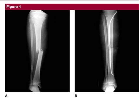 Figure 4 From Tibial Shaft Fractures In Children And Adolescents