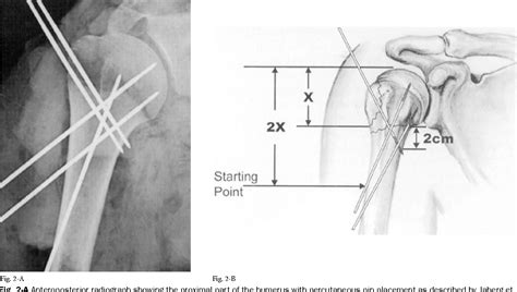 Figure 2 From Literature Management Of Proximal Humeral Fractures Based On Current Semantic