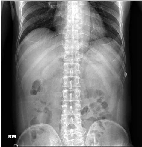 Erect Abdominal X Ray Showed Paralytic Ileus And Fecal Stasis Download Scientific Diagram