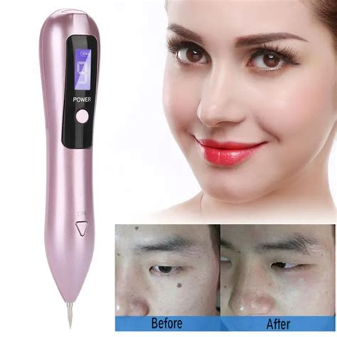 Digital Portable Cautery Machine For Home Use Skin Tag Removal Warts