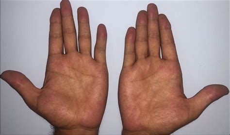 A Case Series And Literature Review Of Erythema Palmare Hereditarium