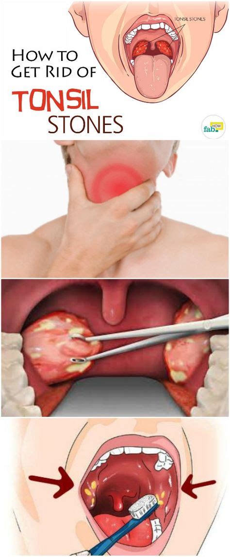 80 Best Tonsil Stones Images On Pinterest Tonsil Stones Natural Home