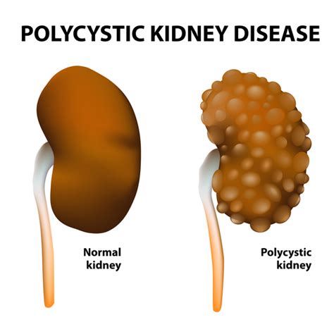 Polycystic Kidney Disease Medlineplus Genetics