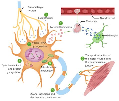 Amyotrophic Lateral Sclerosis Concise Medical Knowledge