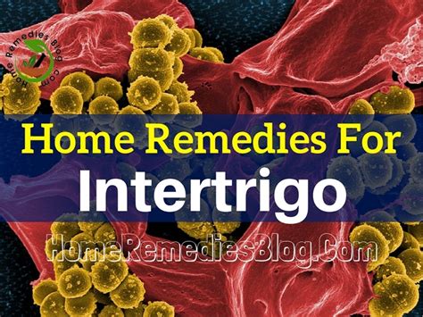 15 Home Remedies For Intertrigo Rash In The Skin Folds